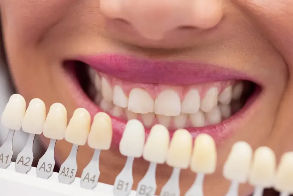 Blanqueamiento dental en casa vs en clínica: diferencias reales