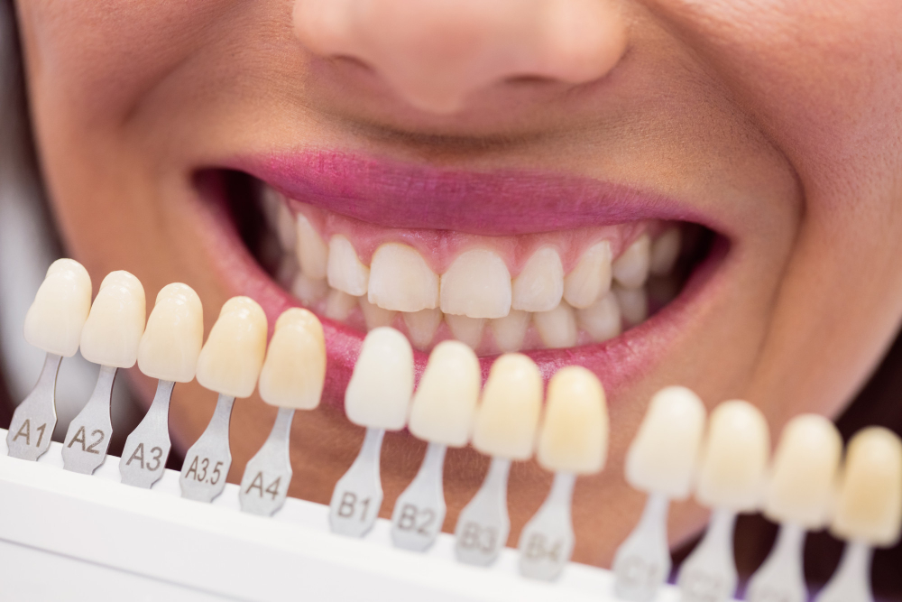 Blanqueamiento dental profesional en Concepción: lo que debes saber