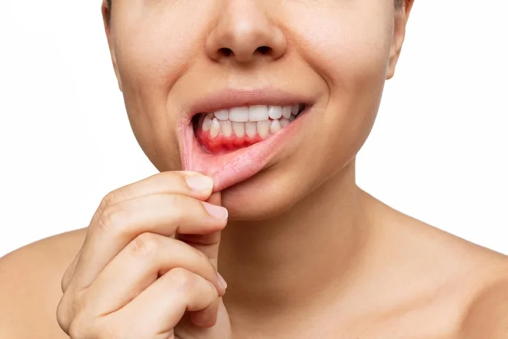 Periodoncia Concepción: Síntomas de la Periodontitis