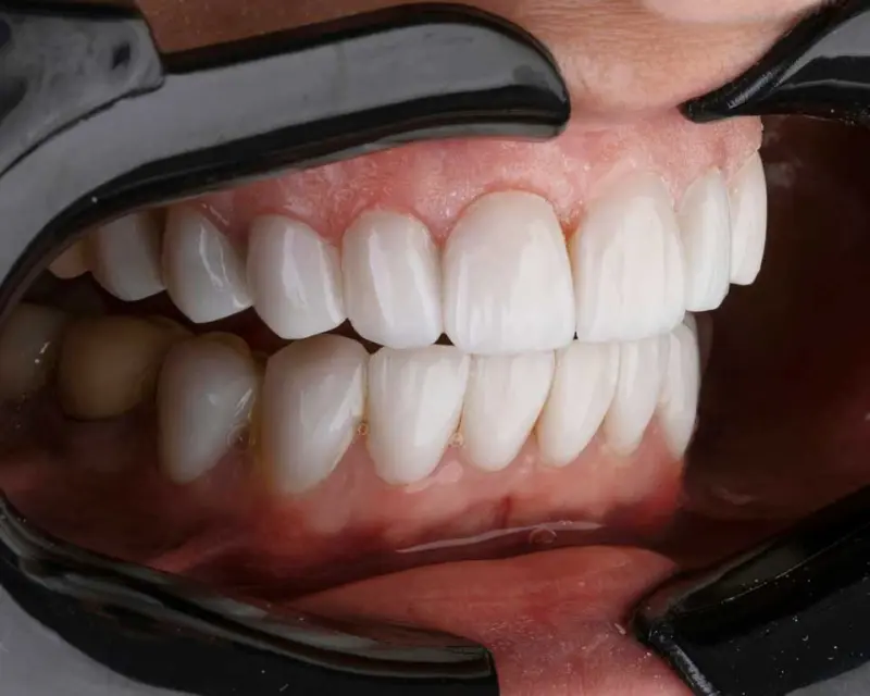 Estética Dental en Clínica KDENT Concepción